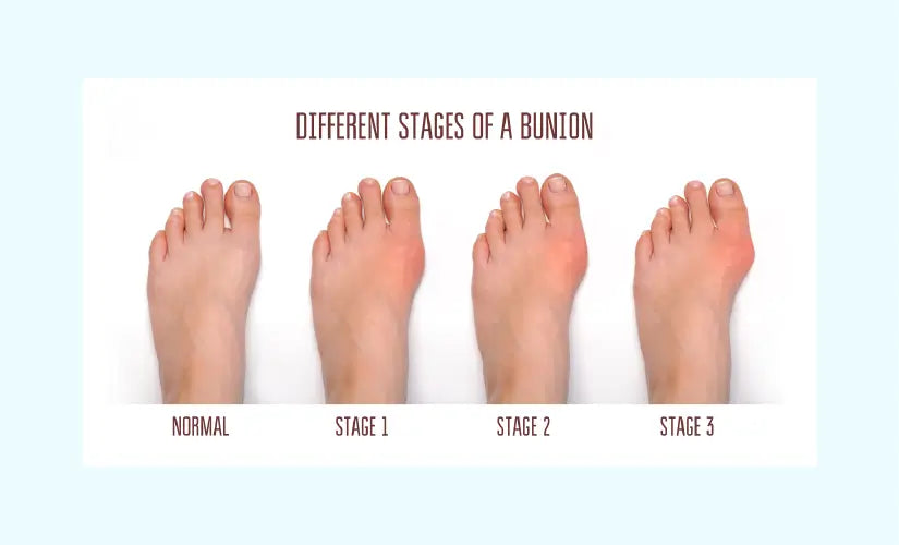 What is a Bunion?